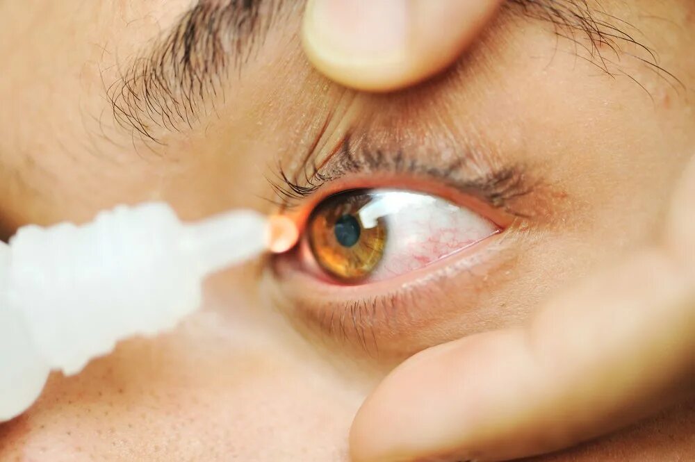 Причины симптома сухого глаза. Кератоконъюнктивит Шегрена.
