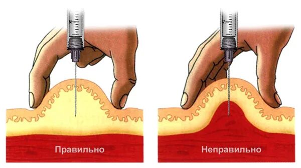 Как правильно колоть железо. Глубина введения внутримышечной инъекции. Подкожно внутрикожно внутримышечно. Инъекция подкожная инъекция техника. Подкожная инъекция глубина введения иглы.