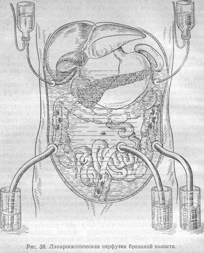 аспирационное дренирование брюшной полости.