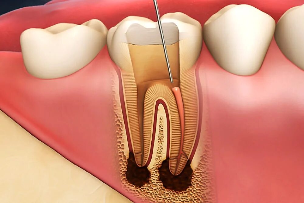Отзывы после лечения зубов. Конкрементозный пульпит. Гипертрофический пульпит.