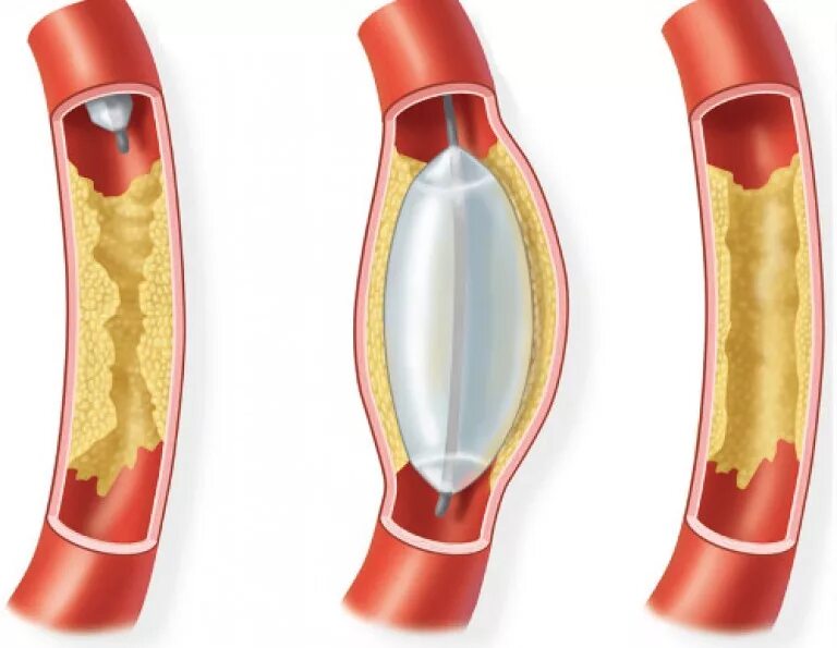 Баллонная ангиопластика и стентирование. Баллонная ангиопластика сосудов нижних конечностей. ТРАНСЛЮМИНАЛЬНАЯ ангиопластика сосудов. Баллонная ангиопластика коронарных артерий. Расширяет коронарные сосуды