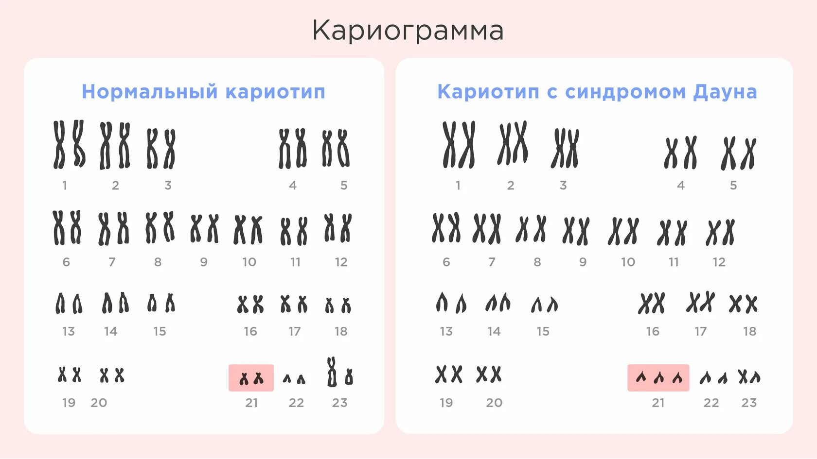 Синдром Дауна кариотип. Кариотип человека при синдроме Дауна. Набор хромосом при синдроме Дауна. Мозаичная форма синдрома Дауна кариотип.