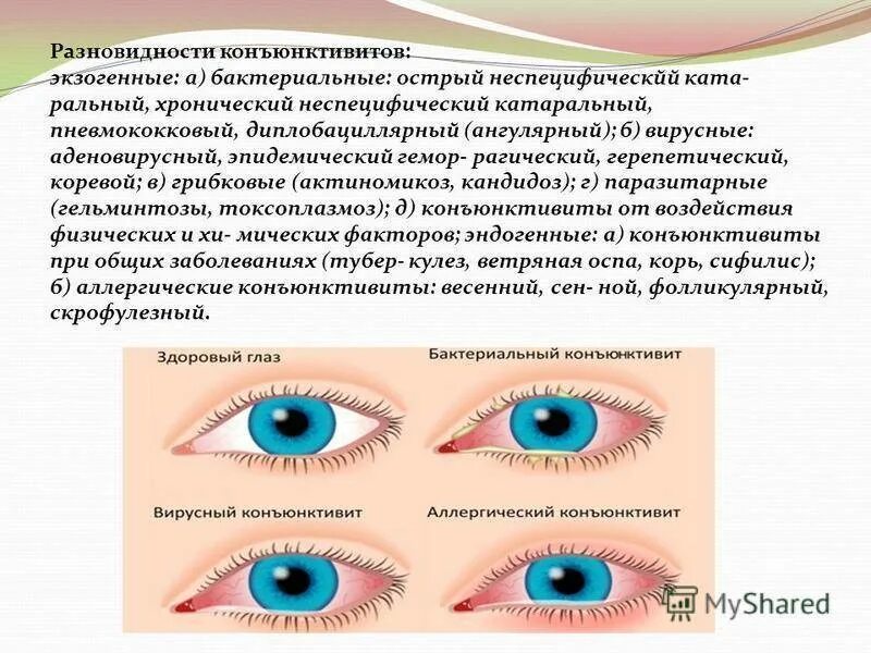 Назовите причины конъюнктивита какую помощь надо оказать. Конъюнктивит капли бактериальный конъюнктивит. Аденовирусная инфекция бактериальный конъюнктивит. Подострый аллергический конъюнктивит. Коньюктивит вирусный конъюнктивит и бактериальный конъюнктивит.