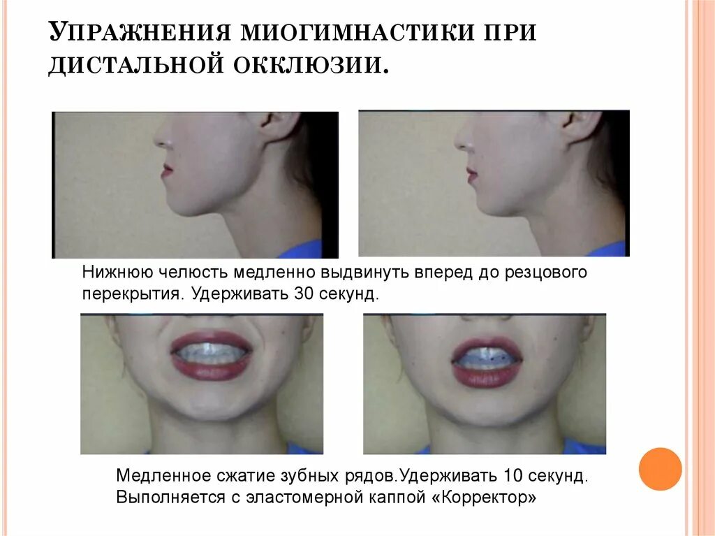 Миогимнастика при открытом прикусе упражнения. Упражнения при дистальной окклюзии. Миогимнастика для дистального прикуса. Упражнения для исправления открытого прикуса. Почему сжата челюсть