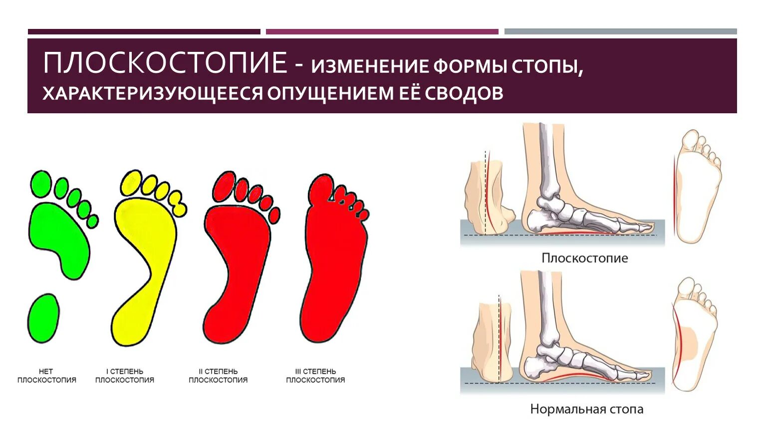 Средняя стопа. Формы плоскостопия. Форма стопы плоскостопие. Типы плоскостопия. Классификация плоскостопия.