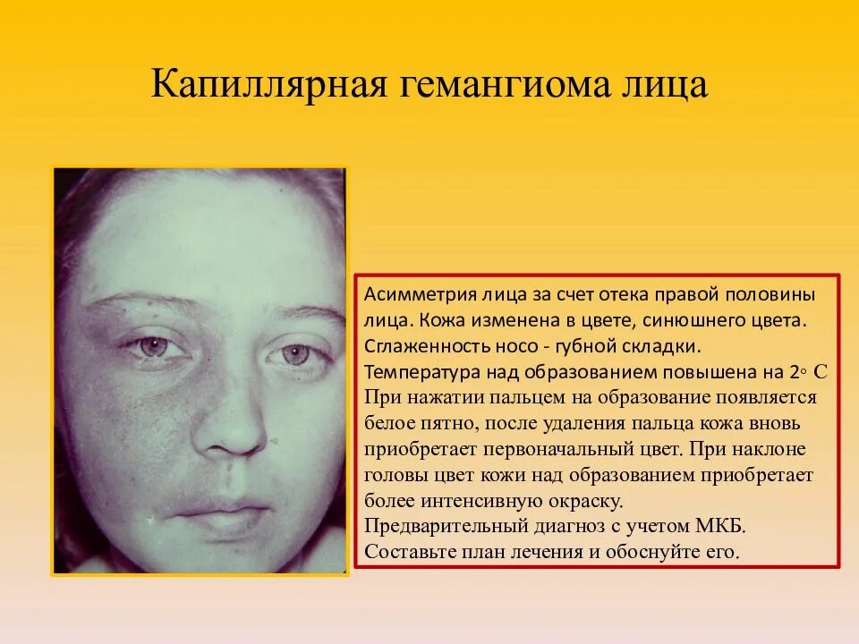 Выражен отек мягких тканей. Кавернозная гемангиома лица. отек правой половины лица. припухлость половины лица.