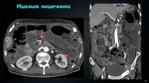 Тромбоэмболия брюшная