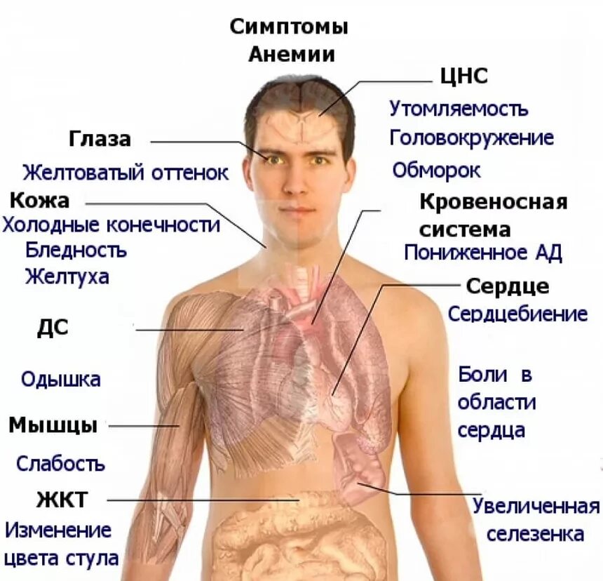 Железодефицитная анемия симптомы. Железонедостаточная анемия симптомы. Симптомы железодеф анемии.