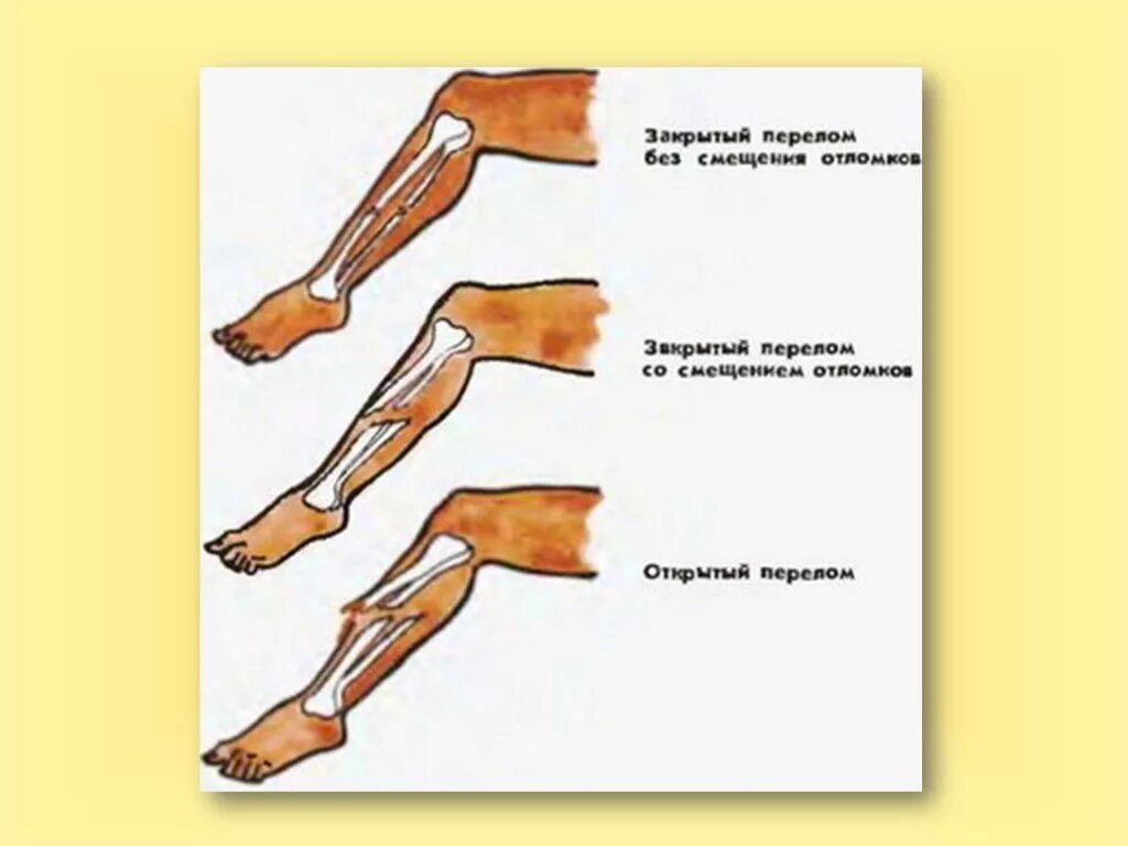 Типы закрытых переломов. Типы переломов конечностей.. Открытый перелом без смещения. Перелом вывих растяжение.
