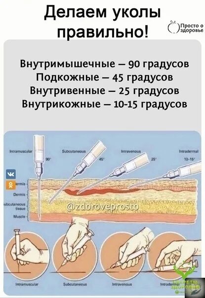 Укол техника выполнения. Как делать укол. Как правильно сделать укол. Как правильно делать УКОСЫ. Как делаются уколы.