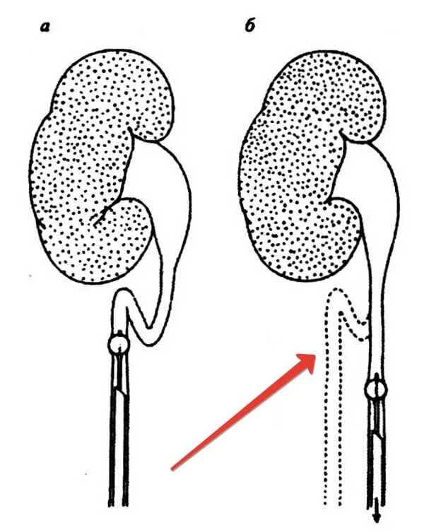 Перегиб мочеточника