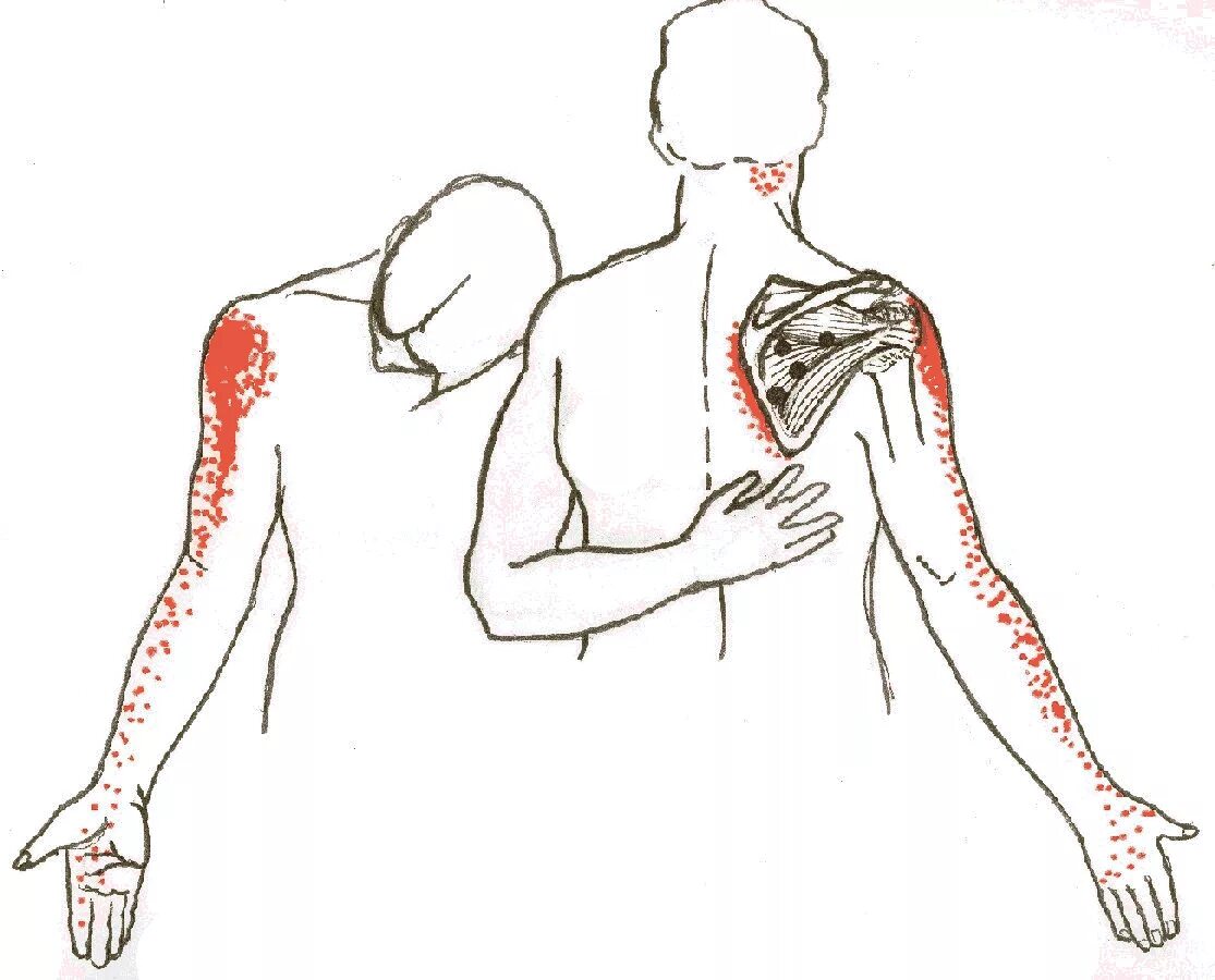 Болит под правым плечом. Триггерные точки подостной мышцы. Подостная мышца плечевого сустава. Подостная мышца плеча триггерные точки. Плечелопаточный периартрит триггерные точки.