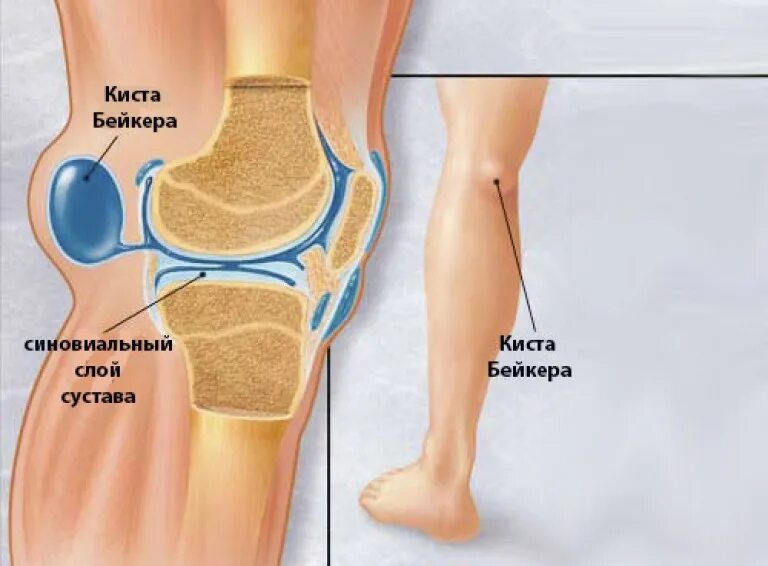 Подколенная киста коленного сустава