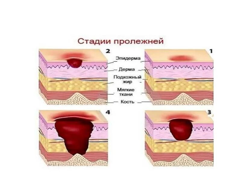 3 й стадии. Пролежни стадии 4 стадии.