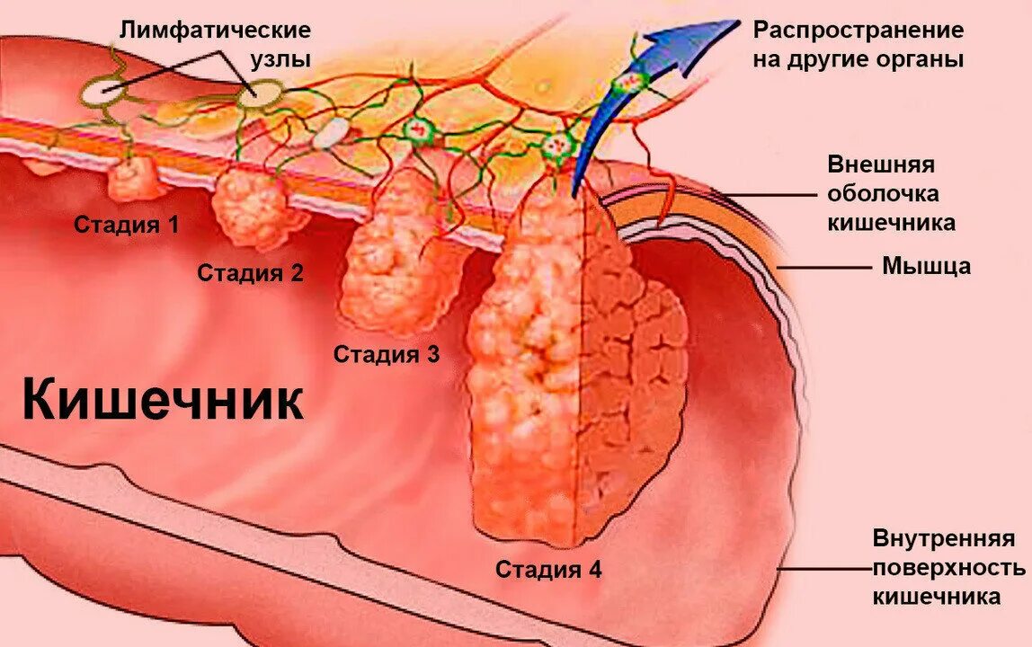 При раке кишечника какие симптомы. Онкология прямой кишки. опухоль прямой кишки симптомы. стадии опухоли толстой кишки.
