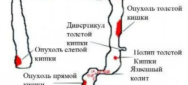 Анализ кала на кровь. Почему из заднего прохода идет. Кровотечения заболевания прямой кишки. Кровотечение из прямой кишки причины. Кровь при дефекации у мужчин без боли.