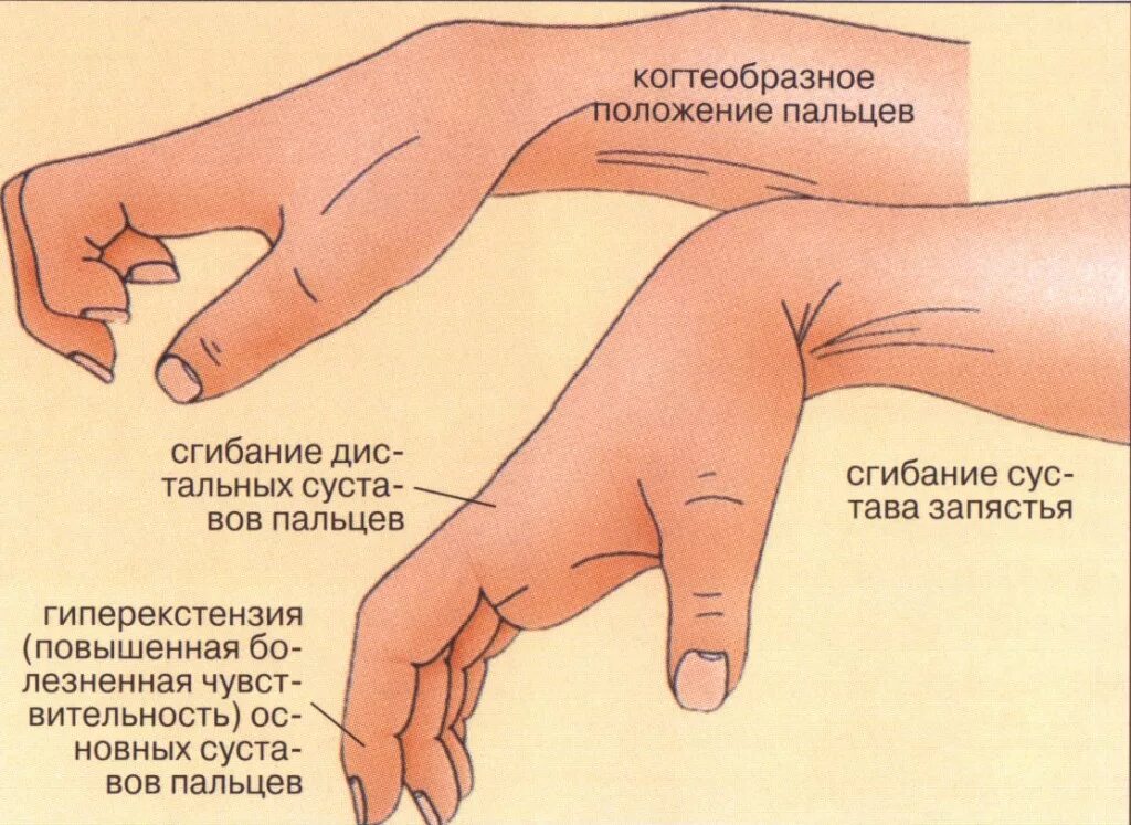 Почему ушла рука. Контрактура лучезапястного сустава. Симптомы повреждения запястья.