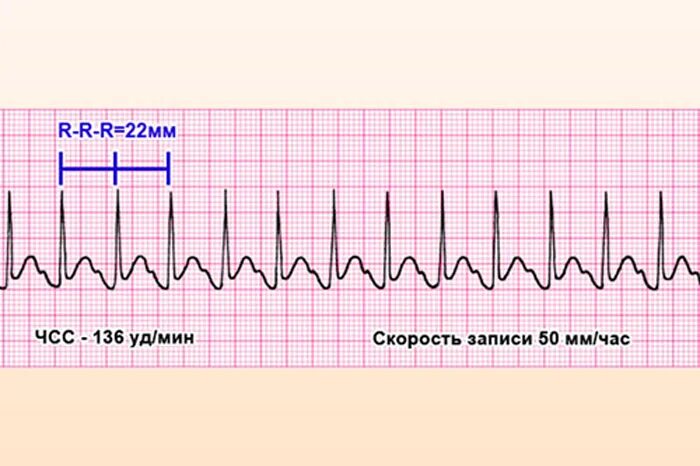 Синусовая тахикардия вертикальное. Синусовая тахикардия на ЭКГ. Синусовая тахикардия ЭКГ признаки. ЭКГ тахикардия синусовый ритм. Синусовая тахикардия схема ЭКГ.