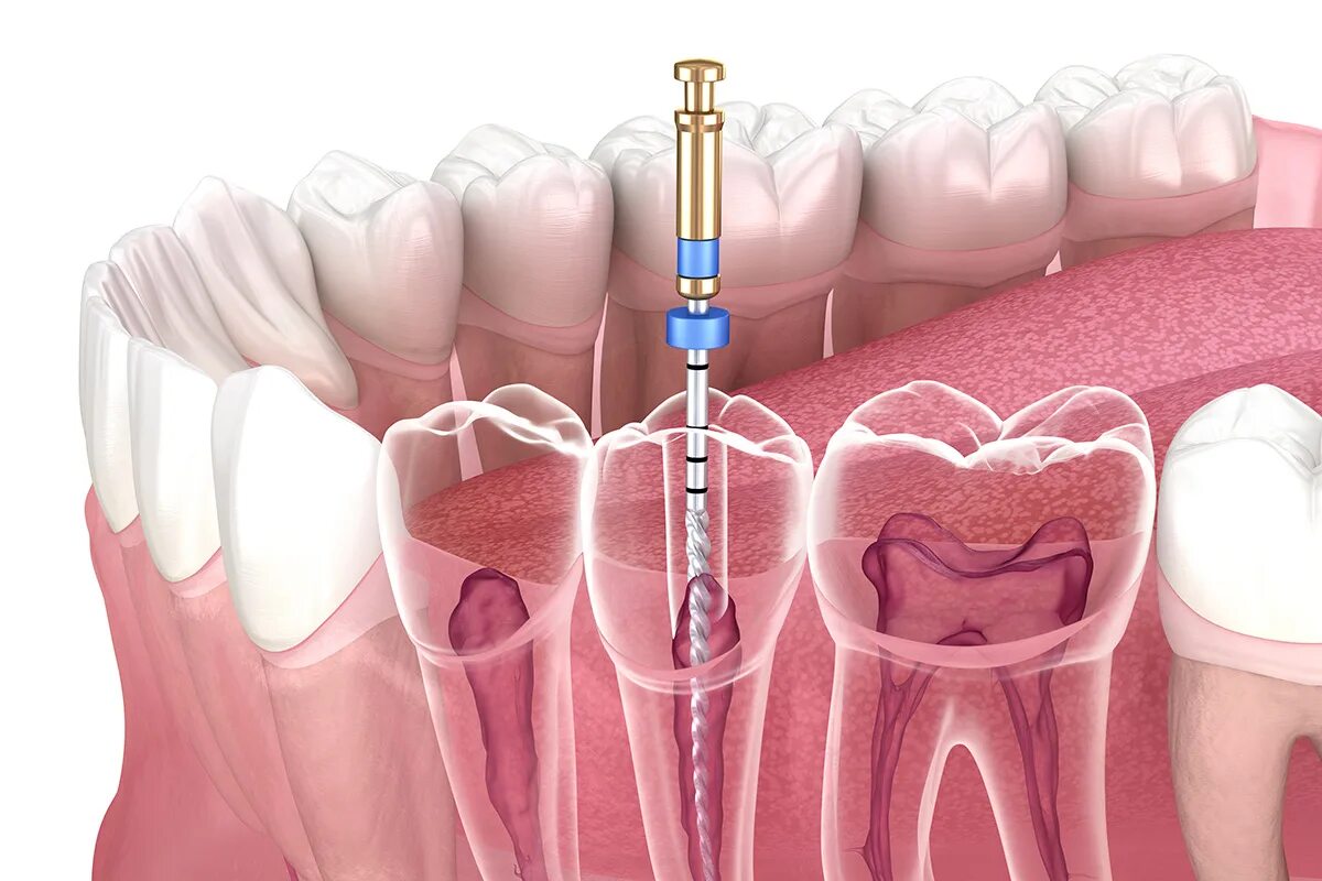 Root canal