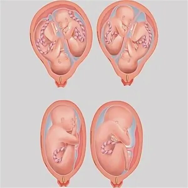 Подсаживали 2 эмбриона. Эмбрион эко прикрепление. Подсадка эмбриона в матку.