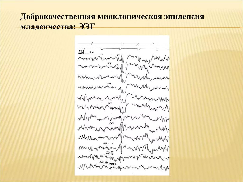 Патологические ритмы ээг при эпилепсии. Ээг при фокальной эпилепсии. Генерализованная эпилепсия ээг. Ээг больного эпилепсией. Ээг головного мозга больного эпилепсией.