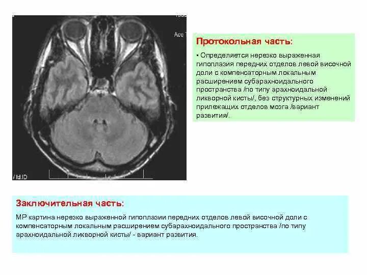 Что значит расширенные субарахноидальные пространства. Что значит расширенные субарахноидальные пространства. Расширение конвекситальных субарахноидальных пространств симптомы. Арахноидальные пространства мозжечка. Субарахноидальное пространство головного мозга мрт.