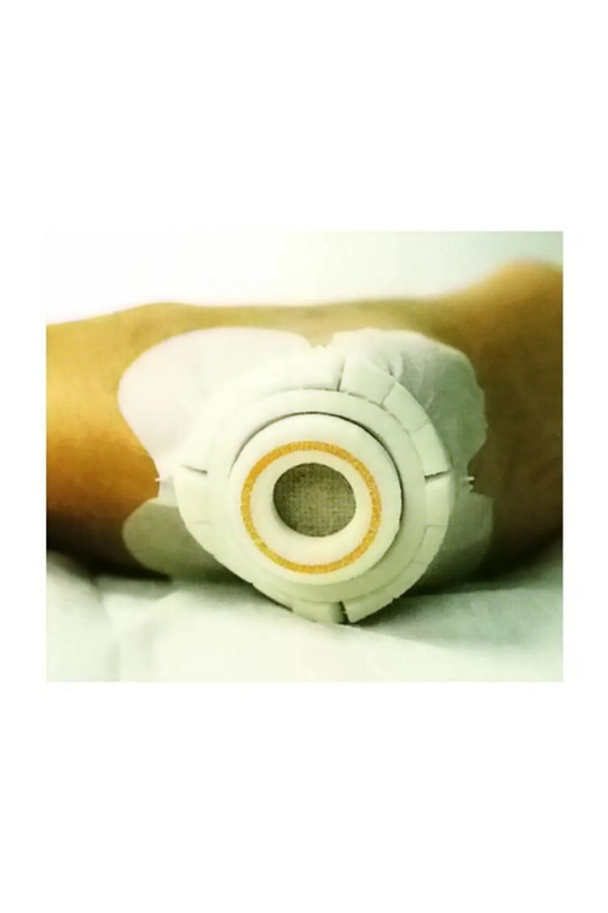 пролежни пятки у лежачих больных