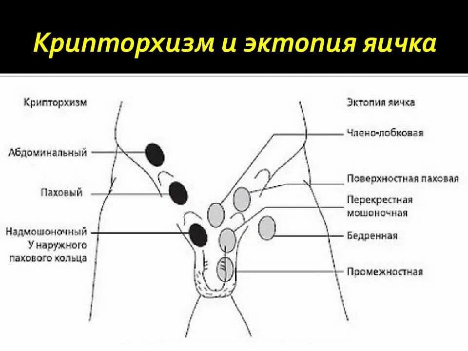 Крипторхизм лечение. Крипторхизм эмбриогенез. Крипторхизм и эктопия яичка.