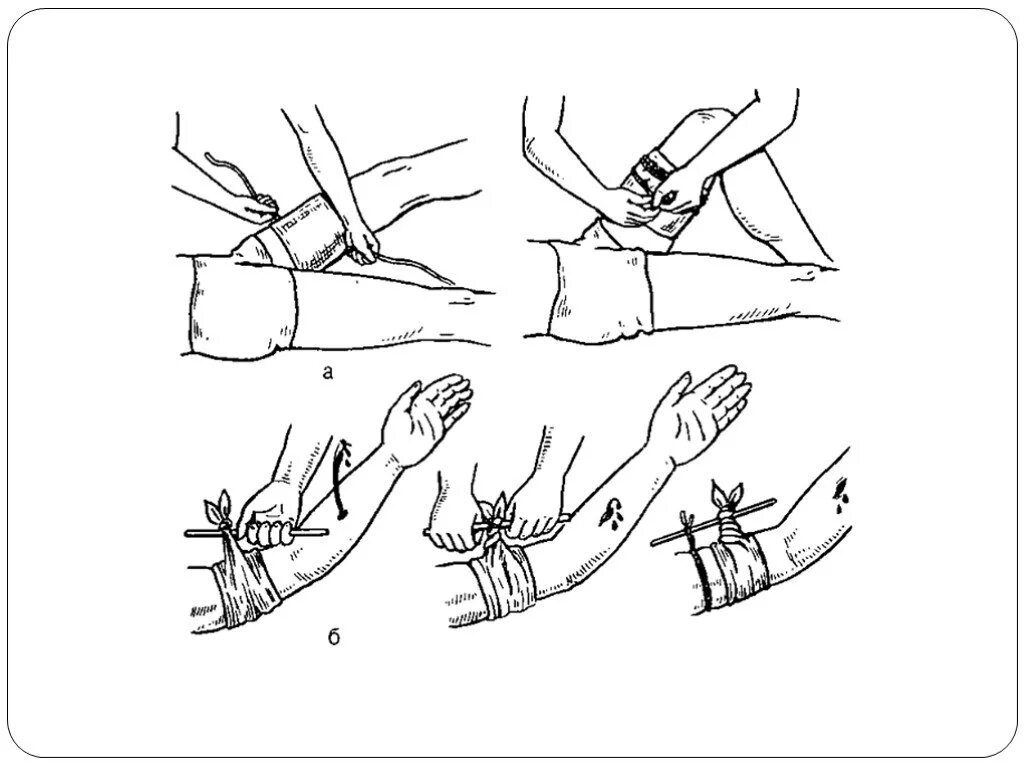 Наложение артериального жгута на нижнюю конечность. Остановка кровотечения накладывание жгута;. Техника наложения жгута закрутки алгоритм. Наложение резинового кровоостанавливающего жгута. Техника наложения кровоостанавливающего жгута на бедро.