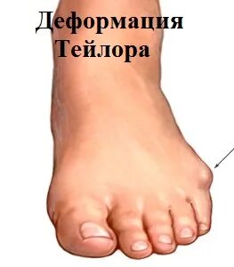 Косточка на мизинце стопы