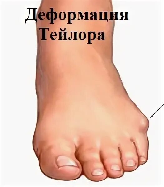Деформация 5 пальца стопы рентген. Деформация тейлора 5 плюсневой кости. Деформация 5 пальца стопы рентген. Деформация тейлора 5 плюсневой кости. Остеотомия wilson 5 плюсневой кости стопы.