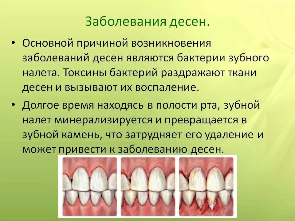 Заболевания пародонта гингивит. Некротический гингивит Венсана. Профилактика катарального гингивита. Гингивит десневые сосочки. Десен системы