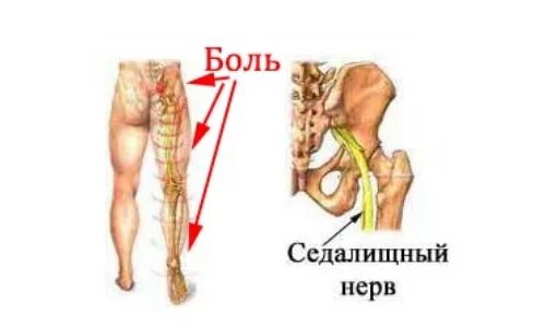 Боль поясница слева отдает в ногу. Люмбоишиалгия поясничного отдела позвоночника. Люмбоишиалгия пояснично-крестцового отдела. Люмбоишиалгический синдром поясничного отдела. Люмбоишиалгия крестцового отдела.