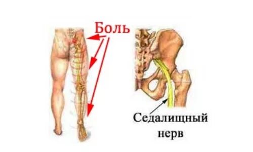 Боль в пояснице. Боль спины справа отдающая в ногу. Боль в пояснице. Боль спины справа отдающая в ногу. Боли в спине и конечностях.
