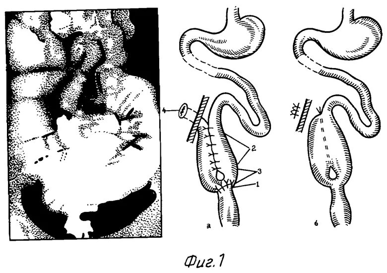 Илеоанальный резервуарный анастомоз. Резервуарный илеоректальный анастомоз. Тонкокишечный резервуар j. Тонкокишечный анастомоз. Колэктомия это
