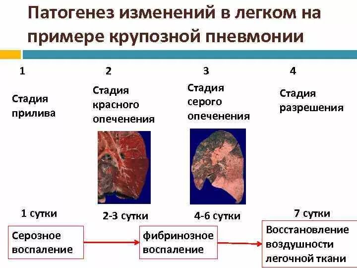 4 стадии изменений. Крупозная пневмония 1 стадия. Крупозная пневмония стадия прилива патогенез. Стадии развития очаговой пневмонии. Стадии воспаления крупозной пневмонии.