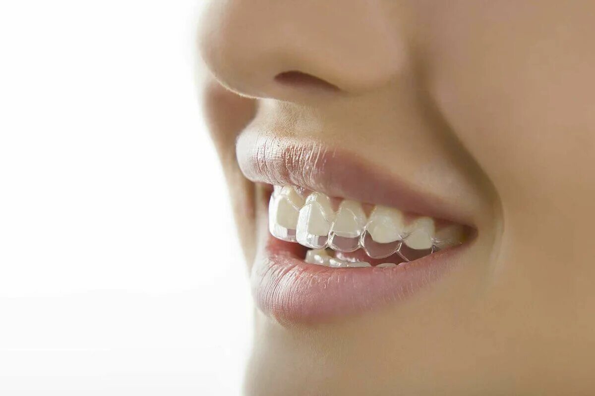 Invisalign