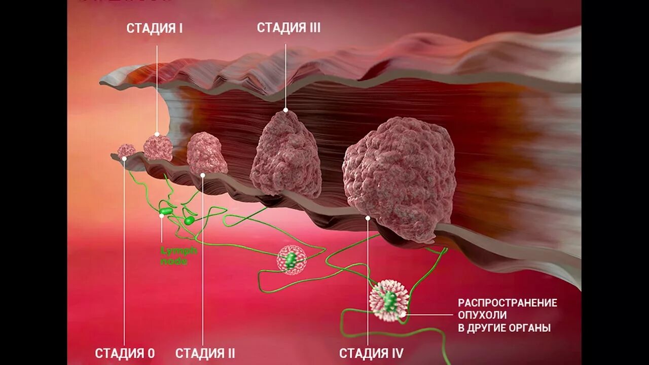 3 стадия рака с метастазами