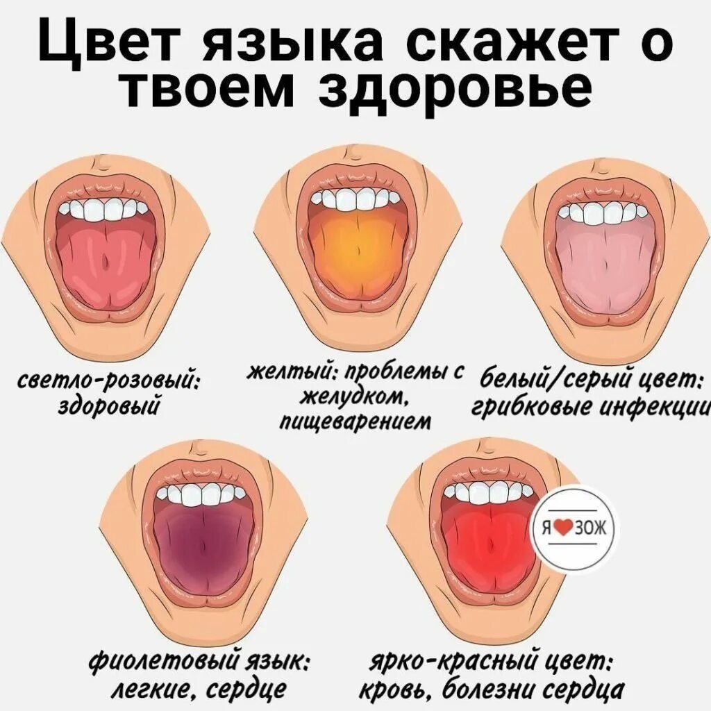 Какого цвета бывает язык. Заболевания по цвету языка. язык здравого человека.