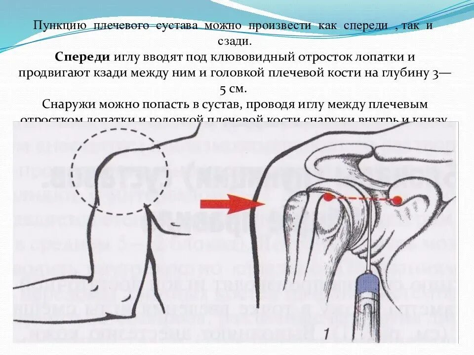 Блокада техника выполнения. Точки пункции плечевого сустава. Точки пункции плечевого сустава топографическая анатомия. Техника введения блокады в плечевой сустав. Пункция плечевого сустава схема.