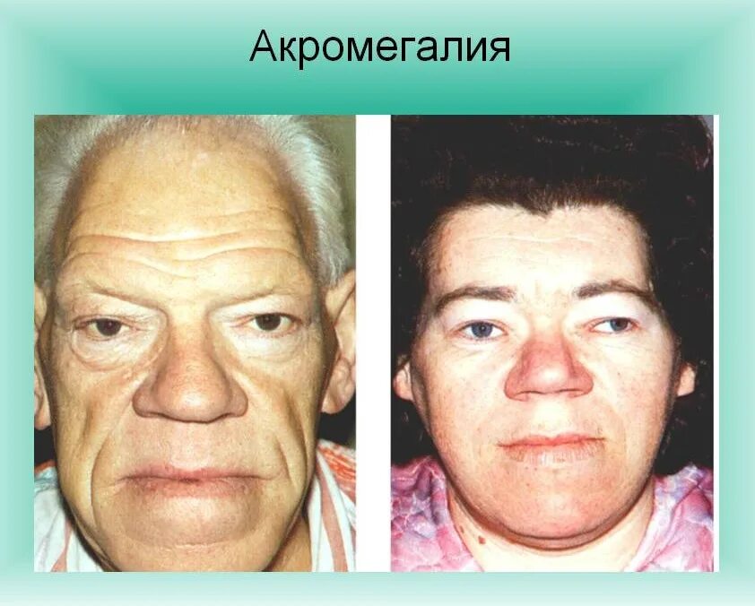 Акромегалия. Клинические проявления акромегалии. Акромиголияакромиголия. Акромегалия патанатомия. Акромегалия.