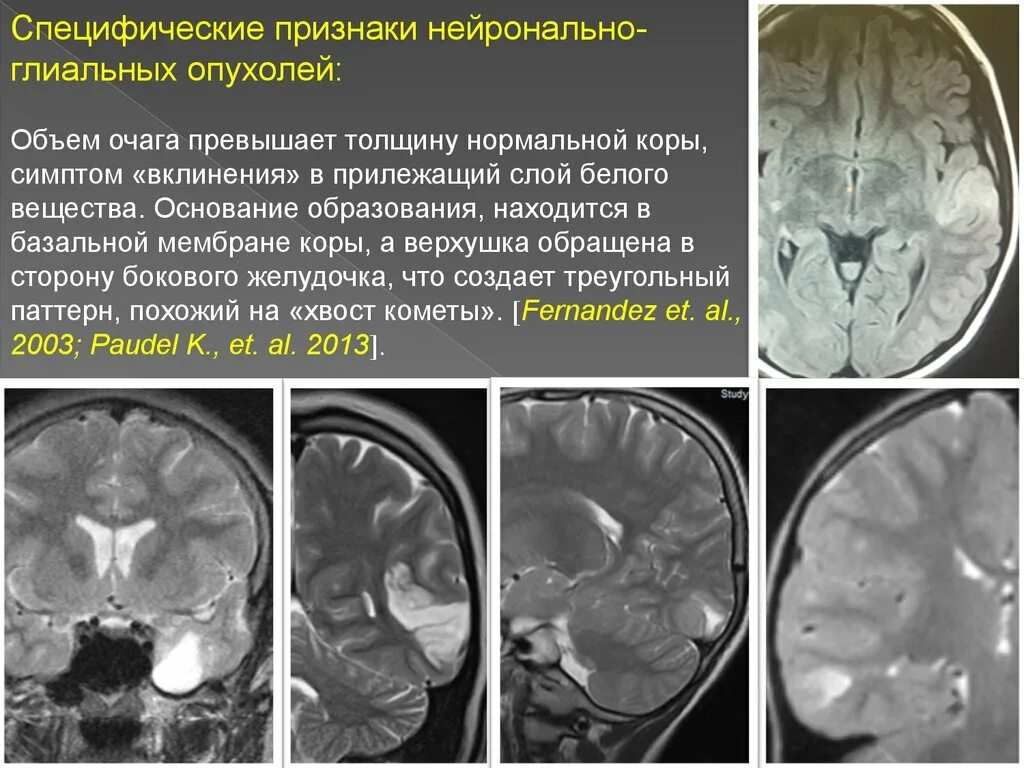 Опухоль специфическим. Опухоль глиального ряда. Глиальная опухоль в гиппокампе.