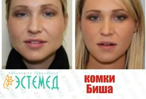 Похудела щека