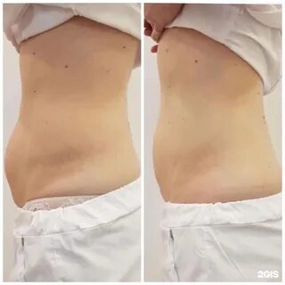 Криолиполиз что это такое отзывы