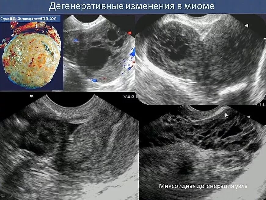 Шеечный миоматозный узел. Некроз миоматозного узла на УЗИ. Узи при миоме матки на какой день