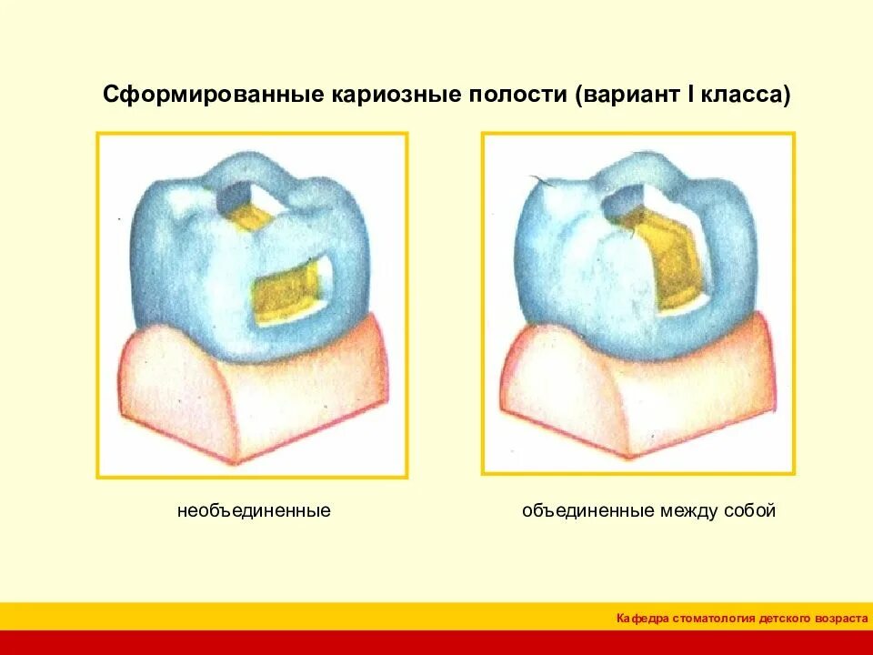 Препарирование полостей по блэку. Препарирование полостей 1 класса по блэку. препарирование кариозных полостей 1 класса по блэку. кариозные полости 1 и 2 класса. кариозная полость 1 класса по блэку.
