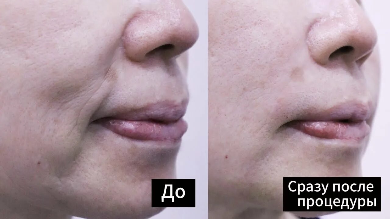 Почему филлеры в губах быстро рассасывается. Мезотерапия носогубных складок. техника введения филлера в носогубные складки. филлеры для носогубных складок. коррекция носогубных складок филлерами.