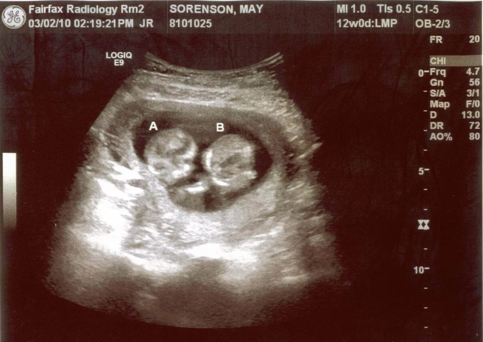 узи 9 недель беременности двойня. узи многоплодной беременности 9 недель. многоплодная беременность на узи 7 недель. узи 8 недель беременности двойня. узи 8-9 недель беременности двойня.