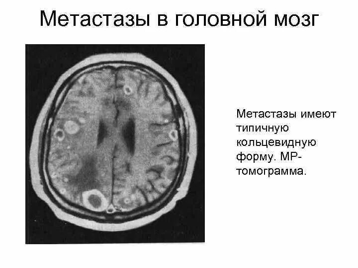 Метастазы в головном мозге. Метастазированием в головной мозг.