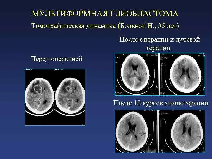 Мультиформенная глиобластома. Глиобластома мультиформная степень 4. Мультиполярная глиобластома 4 степени. Онкология глиобластома.